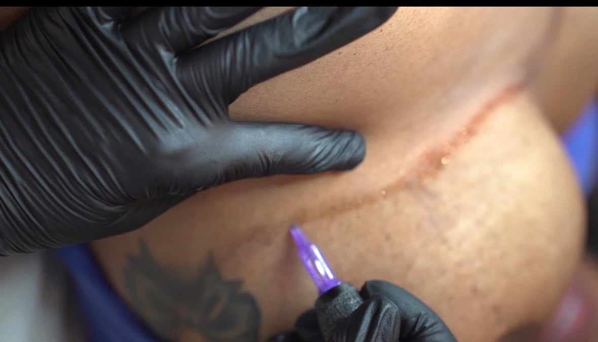 Scar revision treatment